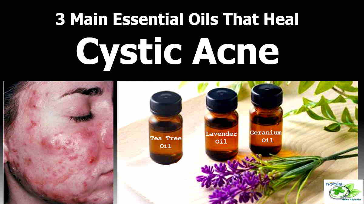 Essential Oils for Cystic Acne Top 3 Oils for Your Pimples