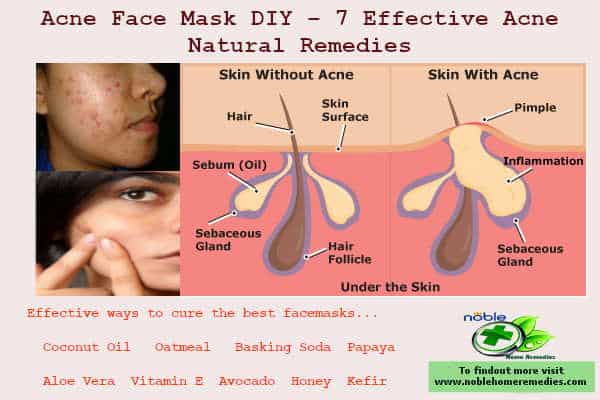 Acne Face Mask DIY – 7 Effective Acne Natural Remedies Acne Face Mask DIY – 7 Effective Acne Natural Remedies