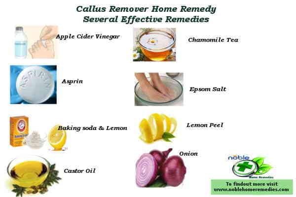 Callus Remover Home Remedy - guide