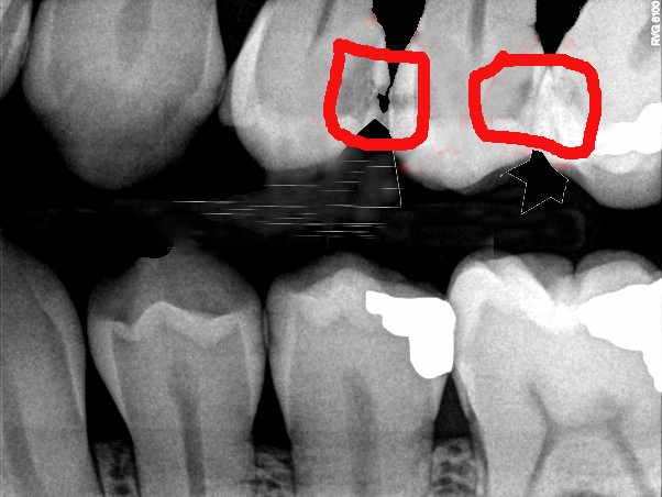 what does a cavity look like on an x-ray
