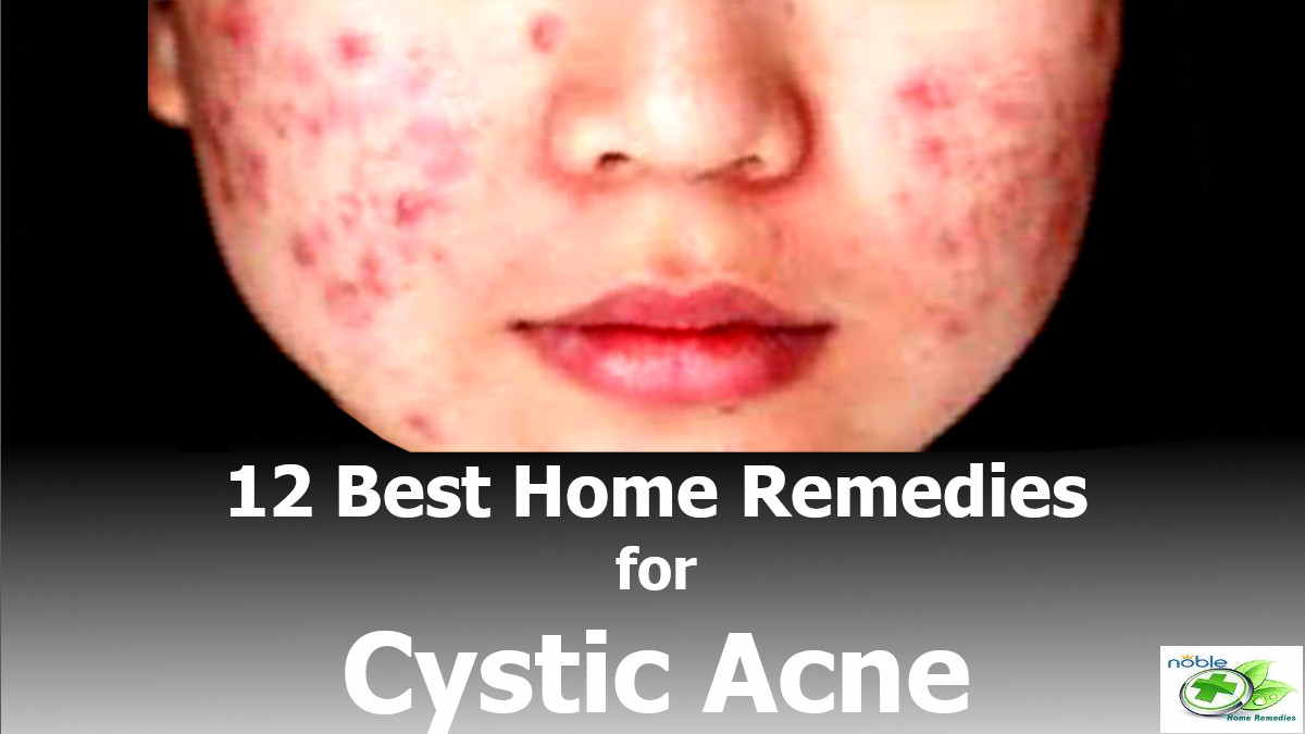 Get Rid of Cystic Acne12 Best Home Remedies