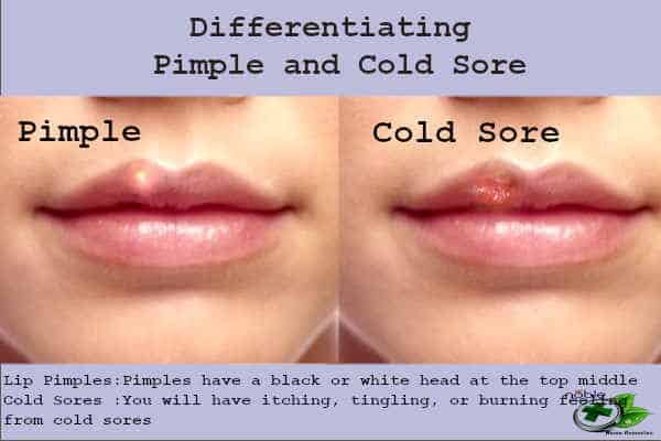 How to differentiate Pimple and Cold Sore
