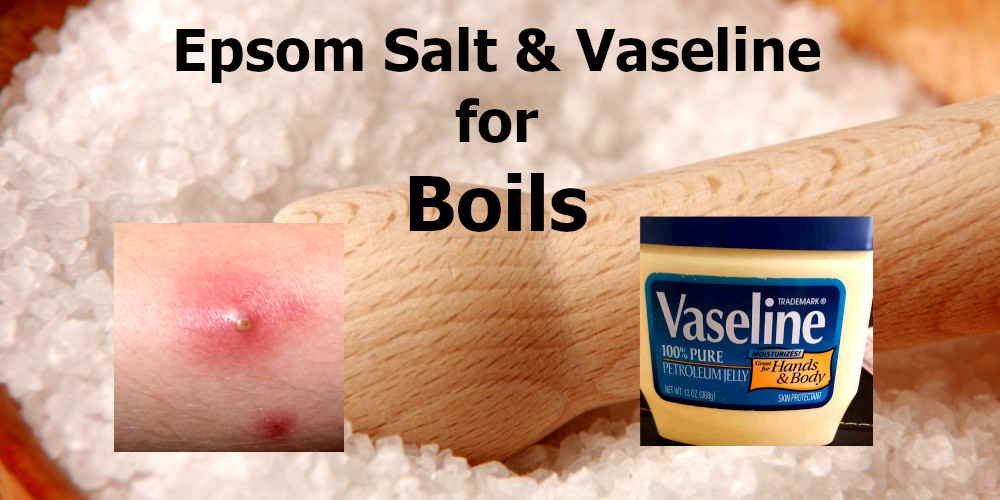 Epsom Salt and Vaseline works for Boils  