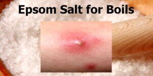 Epsom salt for boils - Natural Remedy