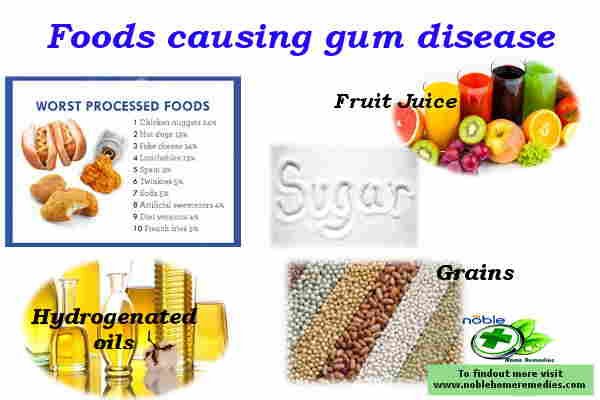 Foods causing gum disease-Natural Treatment Gum Disease