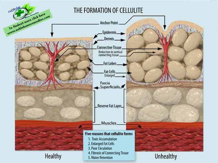Formation of Cellulite