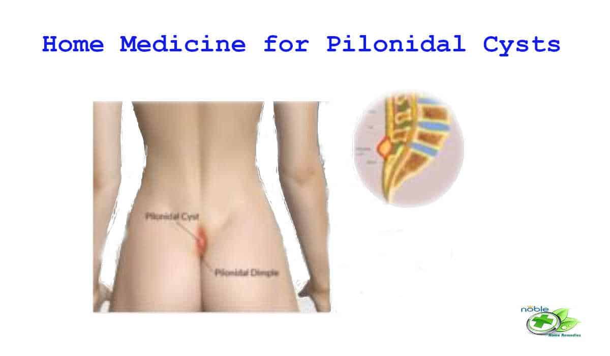 Home Medicine For Pilonidal Cysts Pilonidal Sinus