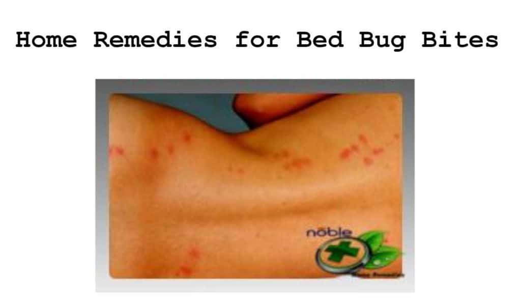 get rid of bed bug bites overnight