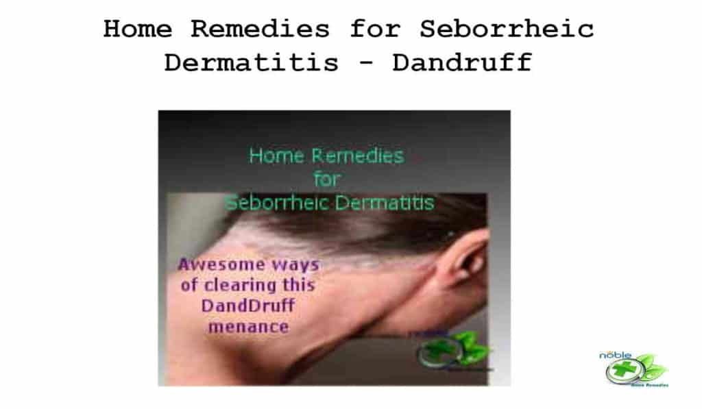 Home Remedies for Seborrheic Dermatitis - Dandruff