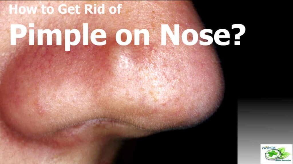 How to get rid of pimples on nose or inside nose