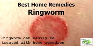 Home Remedies for ringworm are effective in curing