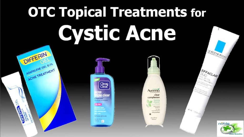 Topical Treatments for Cystic Acne - OTC products
