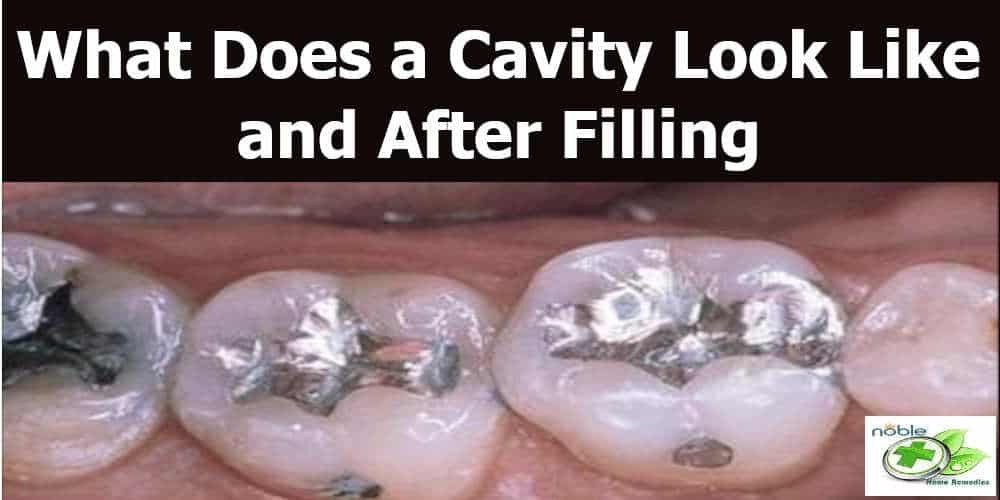 What Does a Cavity Look Like and Can it be reversed?