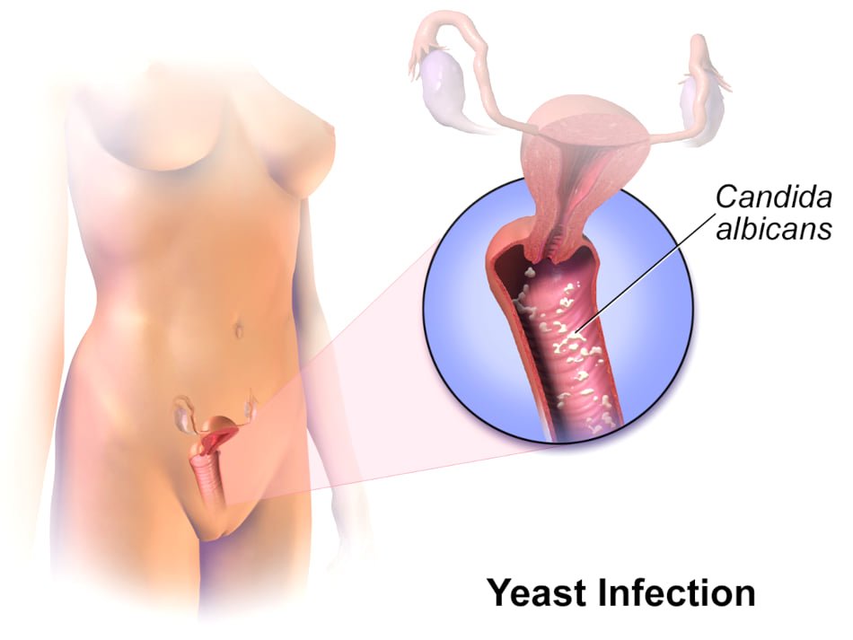 Vaginal Yeast Infection Symptoms, Causes, Treatment