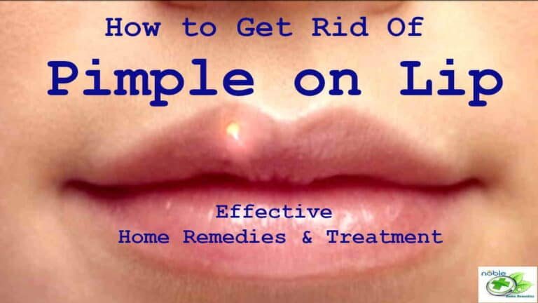 How To Get Rid Of Pimple On The Lip
