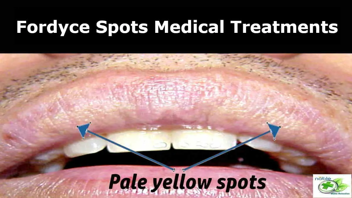 Fordyce spots medical treatments 6 Expert Medical Solutions