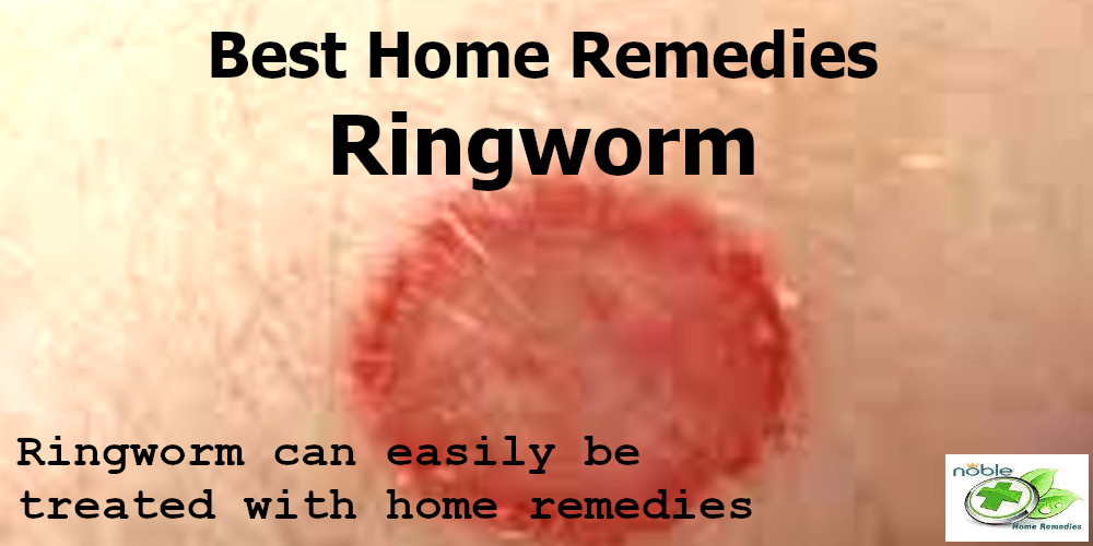 5 Best Home Remedies for Ringworm