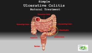 Simple Ulcerative Colitis Natural Treatment - Causes and Symptoms