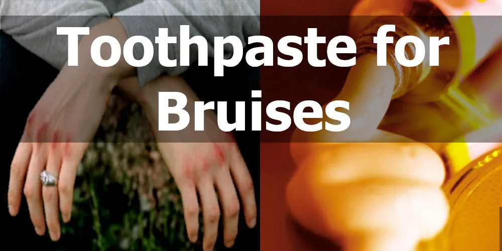 How to Get Rid of Bruises With Toothpaste in Just Minutes!